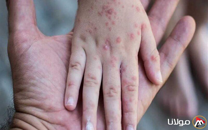 يتفشى في المدارس: تعرف على أعراض الجدري المائي، العلاج، ووسائل الوقاية (في 3 خطوات)