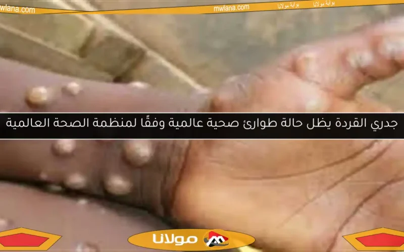 جدري القردة يظل حالة طوارئ صحية عالمية وفقًا لمنظمة الصحة العالمية