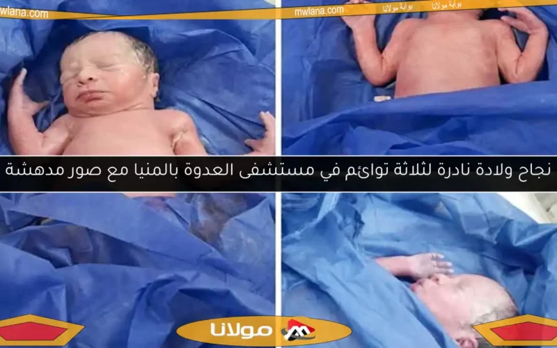 نجاح ولادة نادرة لثلاثة توائم في مستشفى العدوة بالمنيا مع صور مدهشة