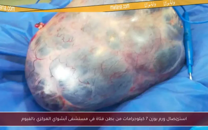 استئصال ورم بوزن 7 كيلوجرامات من بطن فتاة في مستشفى أبشواي المركزي بالفيوم